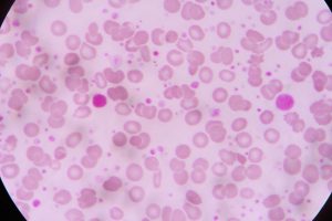 Zeckenbiss im Blut feststellen